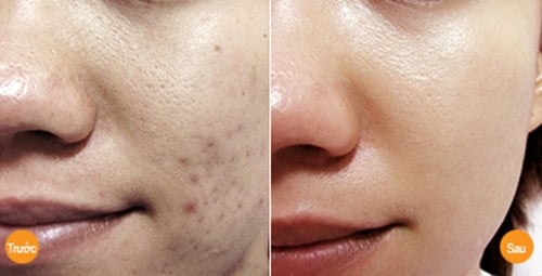 Điều trị mụn sau sinh an toàn,hiệu quả cao tại Green Field spa